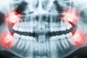 Wisdom Teeth What to know