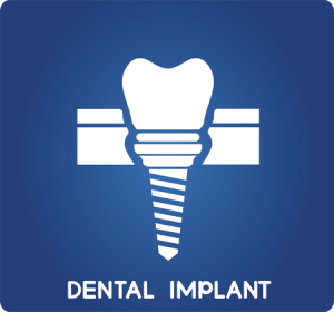 Dental Implants FAQ