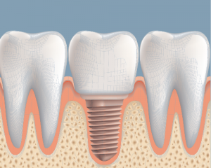 dental implant