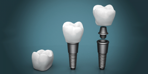 dental implants structure